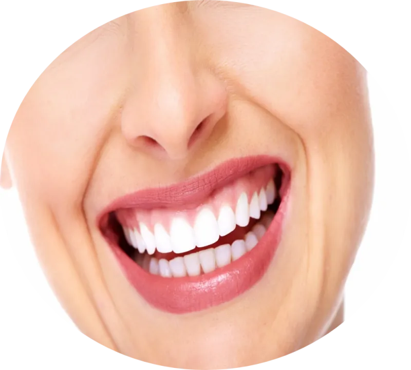 Resultado de lentes de contato dental
